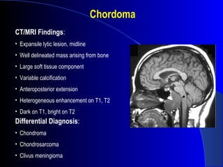 CT/MRI Findings:
• Expansile lytic lesion, midline
• Well delineated mass arising from bone
• Large soft tissue component
• Variable calcification
• Anteroposterior extension
• Heterogeneous enhancement on T1, T2
• Dark on T1, bright on T2
Chordoma
Differential Diagnosis:
• Chondroma
• Chondrosarcoma
• Clivus meningioma
 