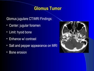 Glomus Tumor
Glomus jugulare CT/MRI Findings:
• Center: jugular foramen
• Limit: hyoid bone
• Enhance w/ contrast
• Salt and pepper appearance on MRI
• Bone erosion
 