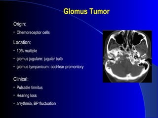 Glomus Tumor
Origin:
• Chemoreceptor cells
Location:
• 10% multiple
• glomus jugulare: jugular bulb
• glomus tympanicum: cochlear promontory
Clinical:
• Pulsatile tinnitus
• Hearing loss
• arrythmia, BP fluctuation
 