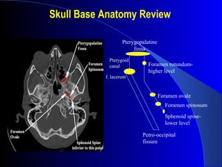 Skull Base Anatomy Review
Foramen spinosum
Sphenoid spine-
lower level
Foramen rotundum-
higher level
Pterygopalatine
fossa
Foramen ovale
Petro-occipital
fissure
Pterygoid
canal
f. lacerum
 