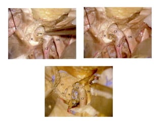 Oculomotor cistern
Cranial nerve III enters the roof included in its own cistern
(oculomotor cistern).
Oculomotor cistern goes upto
anterior clinoid tip
 