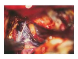 1. In the posterior part of the CS the trochlear nerve is below the oculomotor nerve, while
anteriorly it turns upward and becomes the most superior structure of the CS (at the level of
the optic strut) (Iaconetta et al. 2012 ) .
2. Trochlear nerve is always superior to V1.
 