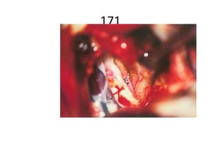 (A) Intraoperative endoscopic close-up view showing the trigeminal nenre and the related neurovascular
anatomy. a Trigeminal nerve (V).
b Superior aspect of cerebellum. c Petrosal veins. d Petrous apex. e Dense araclmoid adhesions (post-Gamma
KnifeX2). f Trochlear nerve (IV).
g Brainstem. h Tentorium. i Tentorial incisura.
From Prof.shahanian endoskull
base book pg 127
 
