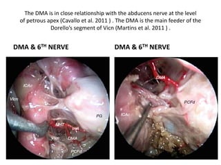 6th nerve origin is above or below AICA or has two
rootlets of origin
 