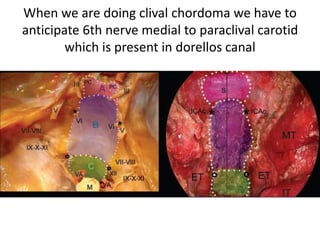 6th is appresiated in TA-II [ Transapical type II ]
approach when 360 degrees IAC drilled
 