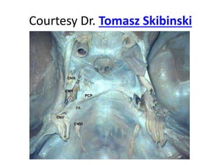 6th nerve – enters the dorellos canal –
Intradural course
 