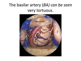 6th nerve – enters the dorellos canal – Intradural course
clinical importance = Gradenigo Syndrome - Infection & inflammation of petrous apex
involves 6th cranial nerve at the Dorello's canal and 5th cranial nerve in the Meckel's
cave
 