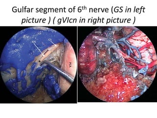 The DMA is in close relationship with the abducens nerve at the level
of petrous apex (Cavallo et al. 2011 ) . The DMA is the main feeder of the
Dorello’s segment of Vicn (Martins et al. 2011 ) .
DMA & 6TH NERVE DMA & 6TH NERVE
 