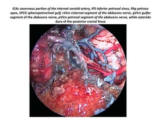 When we are doing clival chordoma we have to
anticipate 6th nerve medial to paraclival carotid
which is present in dorellos canal
 