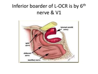 The basilar artery (BA) can be seen
very tortuous.
 
