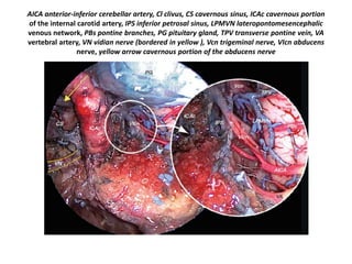 Gulfar segment of 6th nerve (GS in left picture ) ( gVIcn in right picture ) - The
gulfar segment can be identified at the intersection of the sellar floor and the
proximal parasellar internal carotid artery (ICA) (Barges-Coll et al. 2010 ).
 