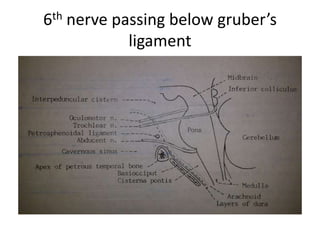 AICA anterior-inferior cerebellar artery, Cl clivus, CS cavernous sinus, ICAc cavernous portion
of the internal carotid artery, IPS inferior petrosal sinus, LPMVN lateropontomesencephalic
venous network, PBs pontine branches, PG pituitary gland, TPV transverse pontine vein, VA
vertebral artery, VN vidian nerve (bordered in yellow ), Vcn trigeminal nerve, VIcn abducens
nerve, yellow arrow cavernous portion of the abducens nerve
 