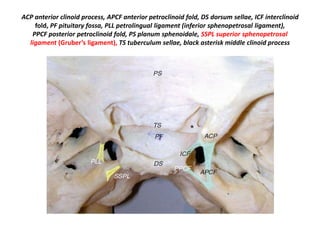 Blue arrow in Left picture ; * in Right
picture - Gruber’s ligament
 