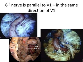 Usually, the IPS passes beneath the superior petro-sphenoidal
ligament (l. of Gruber) with the abducens nerve.
 