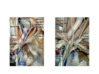Branches of V 1
1. Lacrimal N.
2.Frontal N.
3. Nasociliary N.
Immediately after removing the
periorbita
 