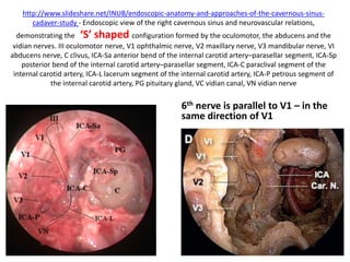 6th nerve passing below gruber’s
ligament
 
