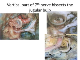 6th nerve is parallel to V1 – in the same direction of V1
 