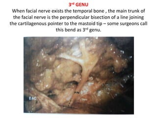 Upper part of S-shaped configuration –
3rd & 6th nerves.
 