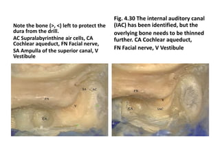 Vertical part of 7th nerve bissects the
jugular bulb
 