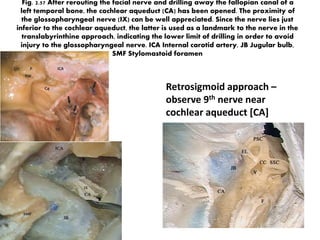 In 50% of the cases mastoid segment of Facial nerve travels
lateral to level of annulus – This is important while removing the
1. EAC in temporal bone malignancy 2. while decompressing the
nerve in malignant otitis externa 3. very careful in children
Click
http://www.youtube.com/
watch?v=f0cblTWJQ4k
 