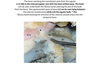 A closer view of the pars nervosa of
the jugular
foramen. The glossopharyngeal nerve
has its own dural
porus, which is situated 0-3 mm
upwards from the dural
porus of the tenth cranial nerve. The
vagus and the accessory
nerve exit the posterior fossa together
in a sleeve of dura
through the jugular foramen.
Left side. The 30° angled endoscope
provides an
overview of the inferior part of the
CPA. On the right lies the
acousticofacial nerve bundle, with
the anterior inferior cerebellar
artery; the glossopharyngeal nerve
and the vagus nerve,
as multiple filaments, form three to
five major nerve bundles
and the accessory nerve.
 