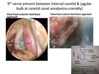 Note the bone (>, <) left to protect the
dura from the drill.
AC Supralabyrinthine air cells, CA
Cochlear aqueduct, FN Facial nerve,
SA Ampulla of the superior canal, V
Vestibule
Fig. 4.30 The internal auditory canal
(IAC) has been identified, but the
overlying bone needs to be thinned
further. CA Cochlear aqueduct,
FN Facial nerve, V Vestibule
 