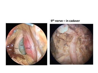 Fig. 2.57 After rerouting the facial nerve and drilling away the fallopian canal of a
left temporal bone, the cochlear aqueduct (CA) has been opened. The proximity of
the glossopharyngeal nerve (IX) can be well appreciated. Since the nerve lies just
inferior to the cochlear aqueduct, the latter is used as a landmark to the nerve in the
translabyrinthine approach, indicating the lower limit of drilling in order to avoid
injury to the glossopharyngeal nerve. ICA Internal carotid artery, JB Jugular bulb,
SMF Stylomastoid foramen
Retrosigmoid approach –
observe 9th nerve near
cochlear aqueduct [CA]
 