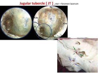 9th nerve present between internal carotid & jugular
bulb at carotid canal area[extra-cranially]
View from anterior skull base
approach
View from Lateral skull base approach
 