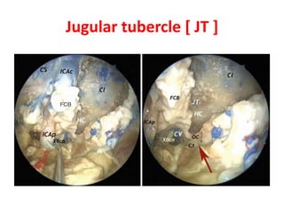 Superior & inferior ganglion of vagus
at jugular foramen
 