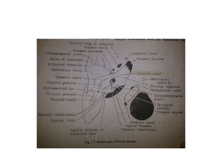 In the cerebello-medullary cistern the LCNs cross the
posterior surface of the JT on their way to JF (Fernandez-
Miranda et al. 2012 ).
Trans-clival approach Retrosigmoid approach
Lateral skull base
approach
 