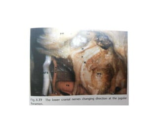 Note the relationship of clivus &
jugular tubercle
 