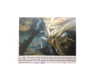Exocranial & Endocranial views of Jugular Foramen : Within the JF
area 2 venous compartement can be identified: a large postero-
lateral_SIGMOID_venous channel and a small antero-medial_PETROSAL_venous
channel which can receive the drainage of the inferior petrosal sinus (IPS). An
intermediary neural compartment is located between the venous ones and houses
lower cranial nerves (IX, X, XI).
CC carotid canal, CR carotid ridge, ESF endolymphatic sac fossa, FS foramen spinosum, IAM internal acoustic
meatus, JT jugular tubercle, OC occipital condyle, PCF petroclival fi ssure, SAF subarcuate fossa, SP styloid
process, SSG sigmoid sinus groove, TB tympanic bone, VPTB vaginal process of the tympanic bone, white
arrow intrajugular process of the temporal bone, red arrow external ori fi ce of the hypoglossal canal, violet
arrow petroclival fi ssure, blue-sky arrow tubal isthmus, black arrow endocranial orifice of the hypoglossal
canal, orange arrow trigeminal impression, green arrow pyramidal fossa, black asterisks intrajugular ridge,
black circle intrajugularprocess of the occipital bone
 