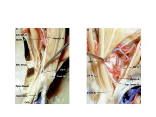 A segment of the orbital portion of the optic
nerve has been removed. This exposes the
branch of the inferior division of the
oculomotor nerve, which passes below the
optic nerve and enters the medial rectus
muscle.
 