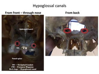 Fig. 26a, b Right side. The root fibers of the hypoglossal
nerve (12) collect in two bundles, which pierce the dura in
two dural pori. The hypoglossal nerve is situated more anteriorly
and medially than the root fibers of the lower cranial
nerves. The arterial relationship is the vertebral artery, with
perforating arteries to the brain stem. The curved vertebral
artery displaces and stretches the hypoglossal nerve fibers.
 