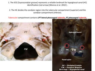 Through lateral skull base - The curved
vertebral artery displaces and stretches the
hypoglossal nerve fibers.
Through lateral skull base - The opposite
vertebral artery exits from the dural porus
and stretches /raises the hypoglossal nerve.
 
