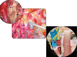 SCG = Supracondylar groove
 