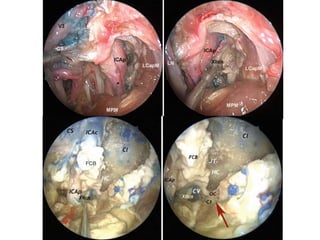 Hypoglossal canals
From front – through nose From back
 
