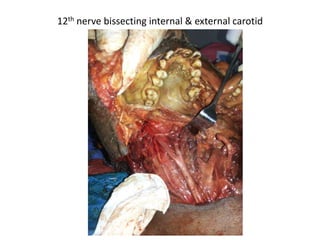 Coronal cut – hypoglossal canal
 