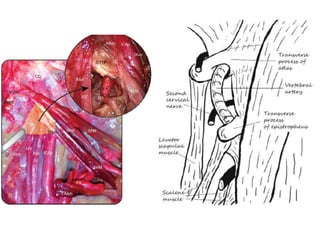 Transoral approach to SUPERO-MEDIAL Parapharyngeal
tumors – incision anterior to anterior pillar of tonsil
 