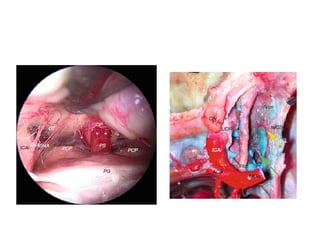 The entrance of the vertebral artery is the boundary between the foramen
magnum and the spinal part of the accessory nerve.
The root fibers of the spinal accessory
nerve and the fibres of C1 and C2
 