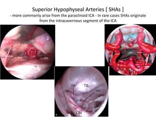 Fibrous tissue surrounds the entrance of
the vertebral artery into the CPA.
Left side. Combined transsigmoid, suboccipital
and extreme lateral approaches provide an
overview off the craniocervical junction, the
foramen magnum area, and the surrounding
structures of the medullary stem.
 