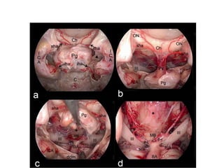 In transcochlear approach
 