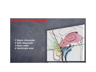Anterior cranial fossa
 