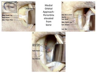 Inferior orbital muscle is completely
muscle , whereas Sup.Obl.M is muscle &
tendinous
 