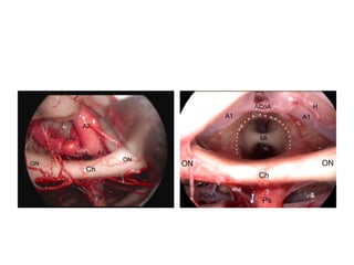 Superior hypophyseal artery =
SHA
 