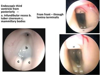 Oculomotor cistern
Cranial nerve III enters the roof included in its own cistern
(oculomotor cistern).
Oculomotor cistern goes upto
anterior clinoid tip
 