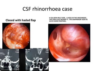 The space between a & oc is Lamina terminalis
Neuroendoscopic view of the third ventricle floor-----Infundibular recess (i), optic chiasm (oc)
and a prominent anterior commissure (a) are seen anterior to the opaque and narrow tuber cinereum (t). B
Neuroendoscopic view of the third ventricle floor in another myelomeningocele patient. A non-transparent
tuber cinereum (t) and a dilated infundibular recess (i) are seen anterior to the mamillary bodies (m). Note to
the vascular structure of the third ventricle floor. cNeuroendoscopic view showing a steep third ventricle
floor in a myelomeningocele patient. A narrow tuber cinereum (t) is visible just anterior to the mamillary
bodies (m). dNeuroendoscopic view through a very narrow prepontine cistern. Note the close proximity of
the basillary artery (ba) and clivus (cl)
 