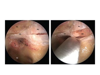 Medial
Orbital
Approach-
Periorbita
elevated
from
bone
 
