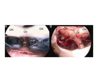 Endoscopic third
ventricle from
posteriorly --
a. Infundibular recess b.
tuber cinereum c.
mammillary bodies
From front – through
lamina terminalis
 