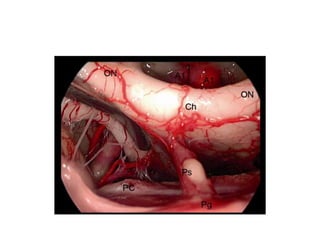 In the descriptive analysis of the 20 specimens, the PCoAs
distance was 9 to 18.9 mm, mean of 12.5 mm, median of 12.2
mm, standard deviation of 2.3 mm.
 